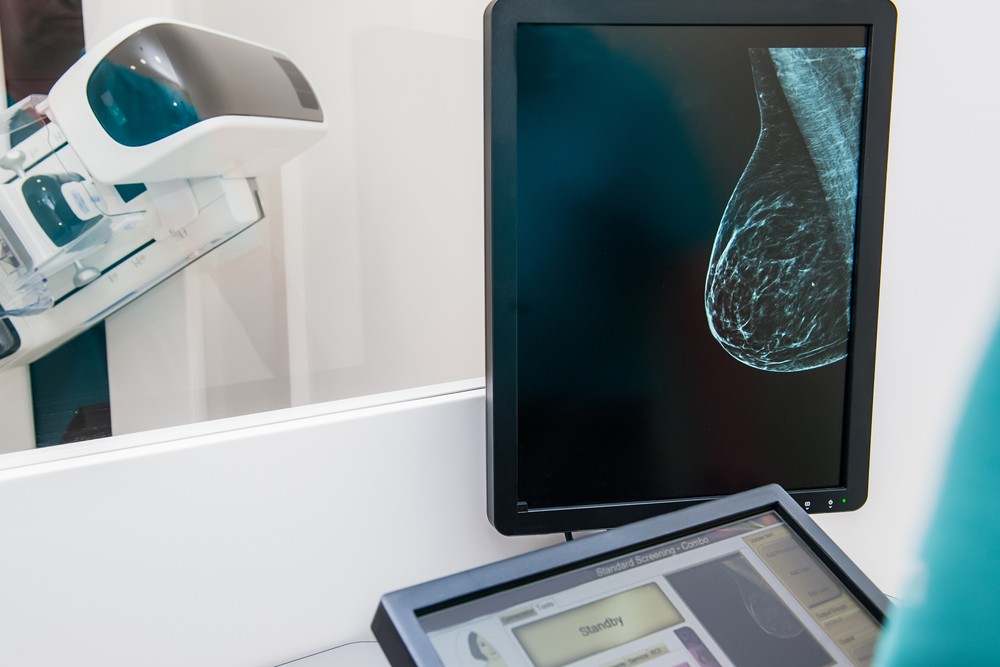 Artificial Intelligence for Breast Cancer Diagnosis