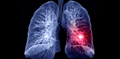 Study Shows CT Screening Reduces Lung Cancer Deaths