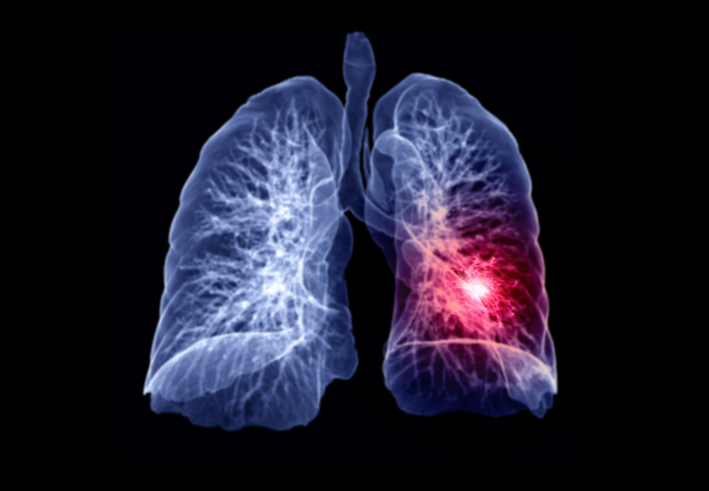 Study Shows CT Screening Reduces Lung Cancer Deaths
