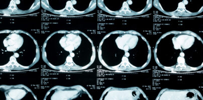 Only 5.8% of People Eligible Receive Lung Cancer Screening